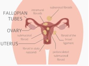 Location of Fibroid