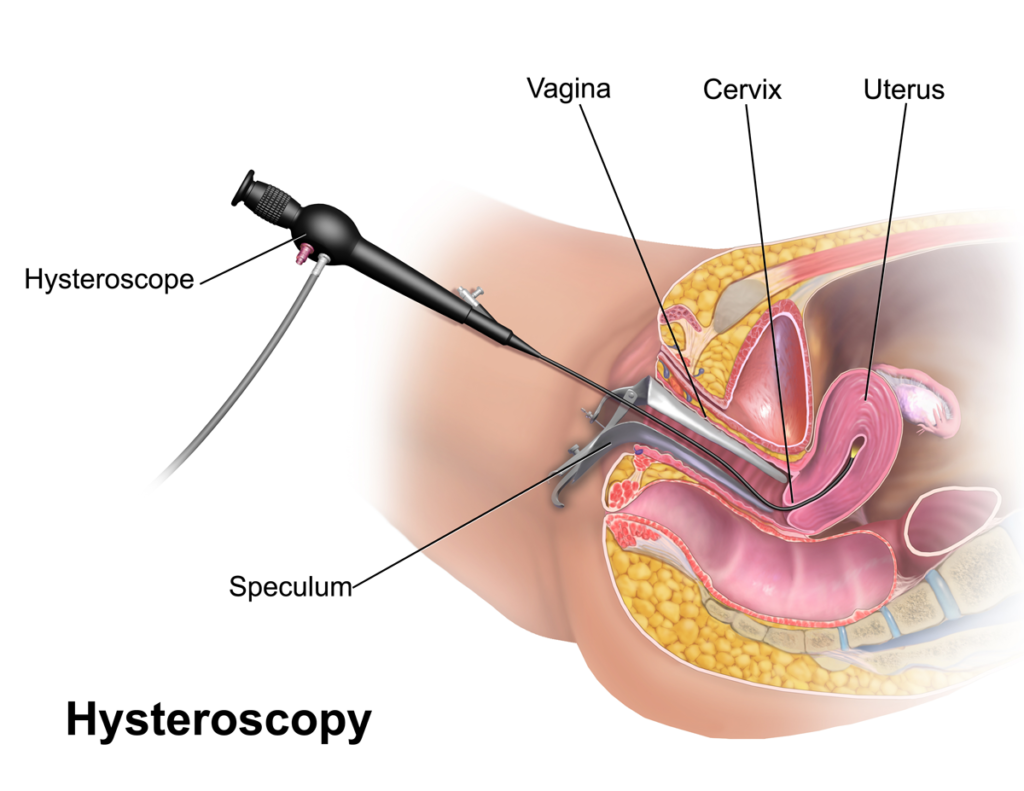 Hysteroscopic Polypectomy Endometrial Polyp