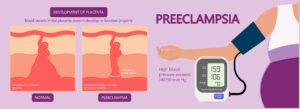Read more about the article Pregnancy Induced Hypertension (Preeclampsia) :
