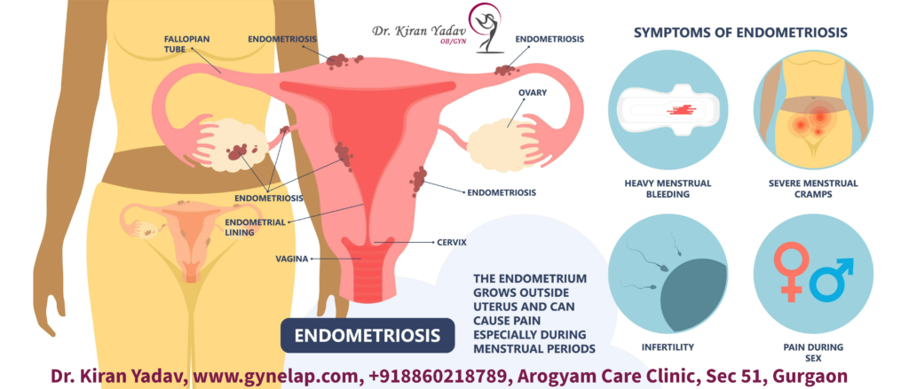 Endometriosis is growth of tissue similar to the lining of the uterus (endometrium) outside the uterus, usually on the ovaries, fallopian tubes, pelvic wall, bladder, bowel, or other organs. causing inflammation, pain, and scar tissue formation, infertility