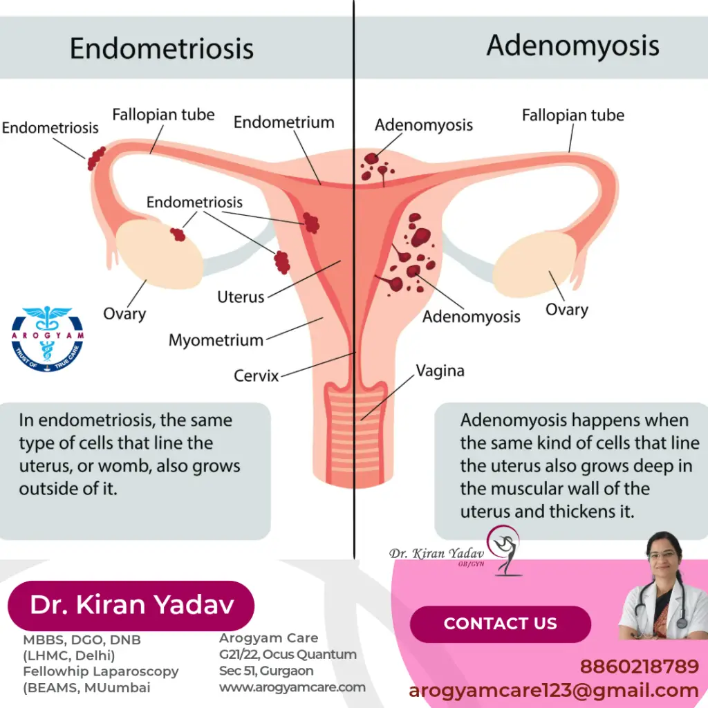 in endometriosis uetrus lining tissue grows outside of uterus and over other organs. In adenomyosis endometrial tissue grows inside the wall of uterus