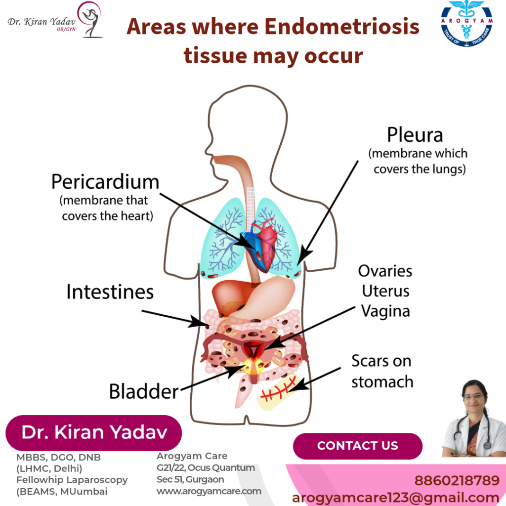 endometriosis can occur in uterus wall, fallopian tube, intestine, rectum, peritoneum. cause pain
