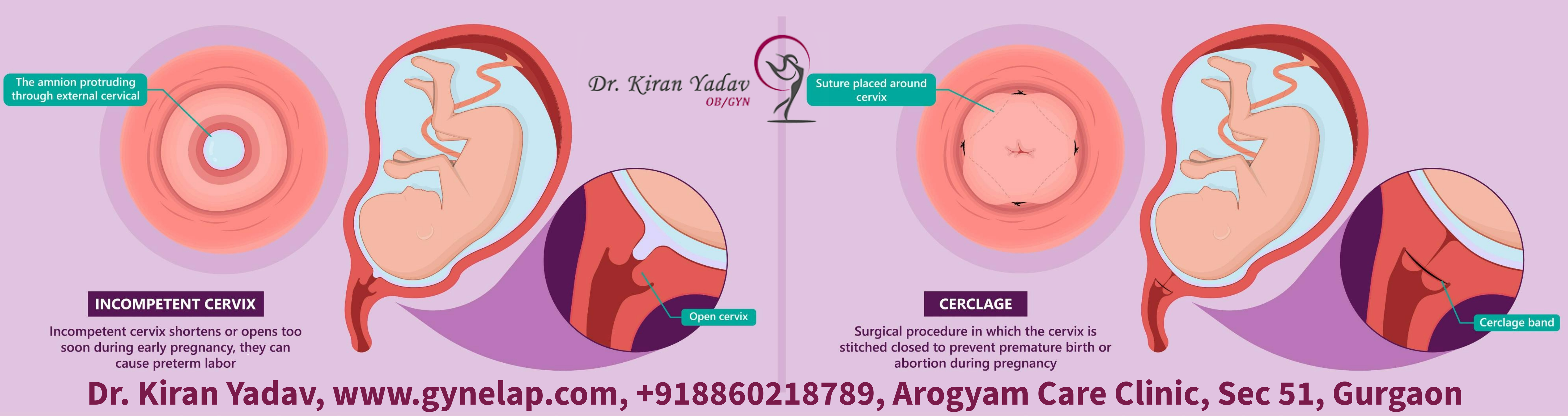 Read more about the article Cervical Stitch: A Lifeline to Protect Preterm Births and Miscarriages