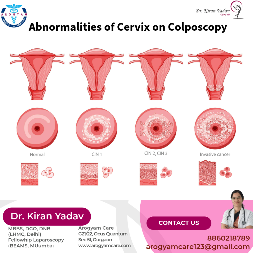 Colposcopy, Cervix abnormality on colposcopy, What is coposcopy
