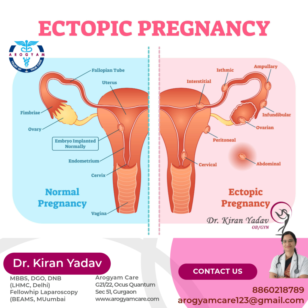 Ectopic Pregnancy: What is ectopic pregnancy