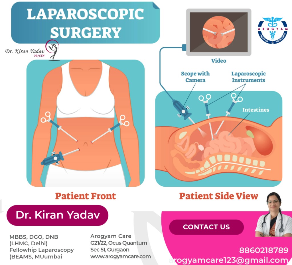 What is laparoscopic surgery