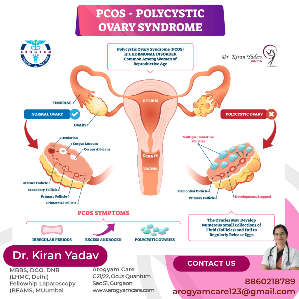 PCOD: What is PCOD or PCOS, What causes PCOD