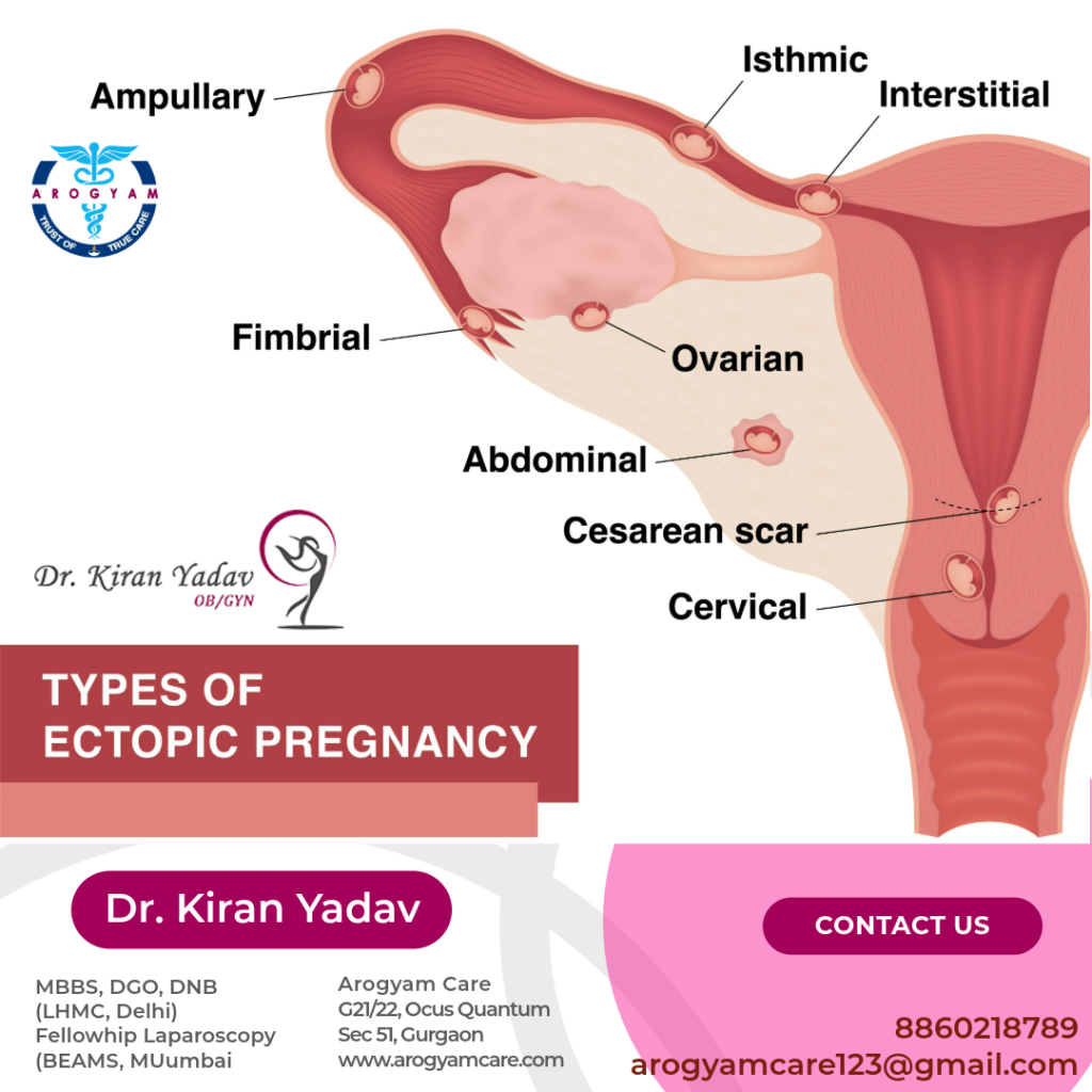 What are the sites of ectopic pregnancy