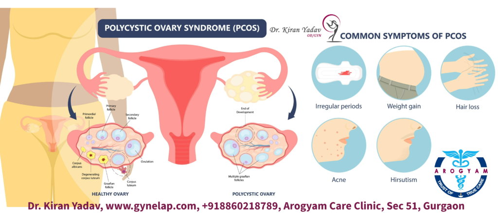 Symptoms of PCOD