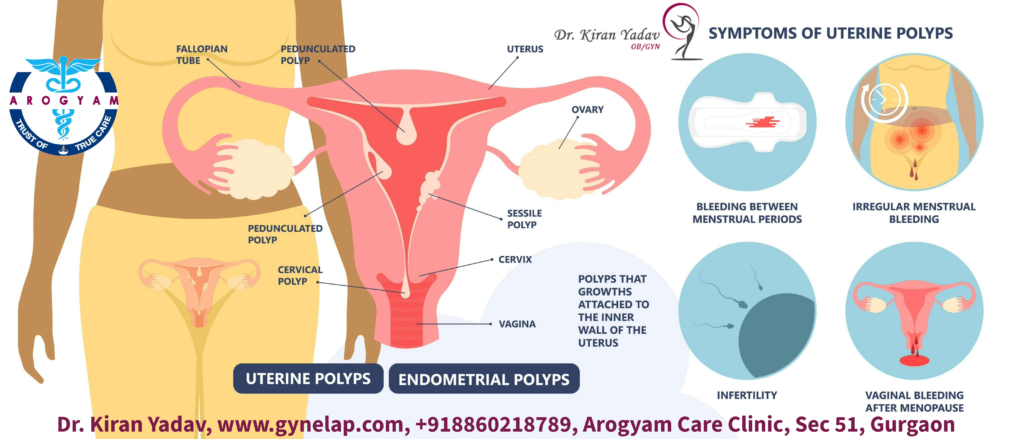 Endometrial Polyp, Symptoms of uterine polyp