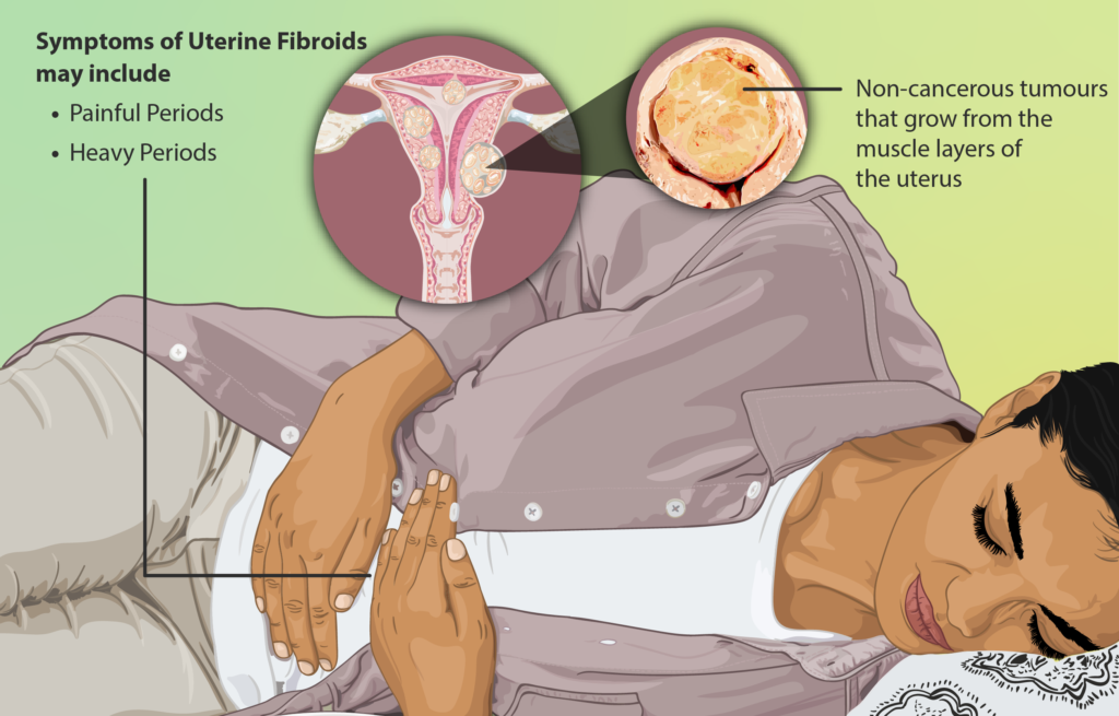 Uterine fibroid causing pelvic pain in young female