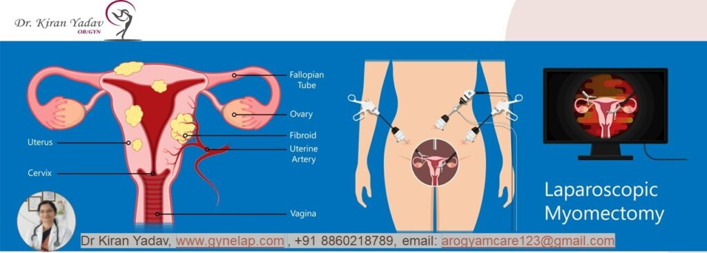 Laparoscopic Myomectomy surgery for Uterine fibroid