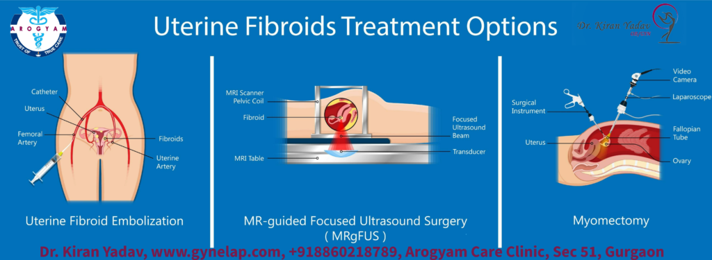 treatment options for uterine fibroid